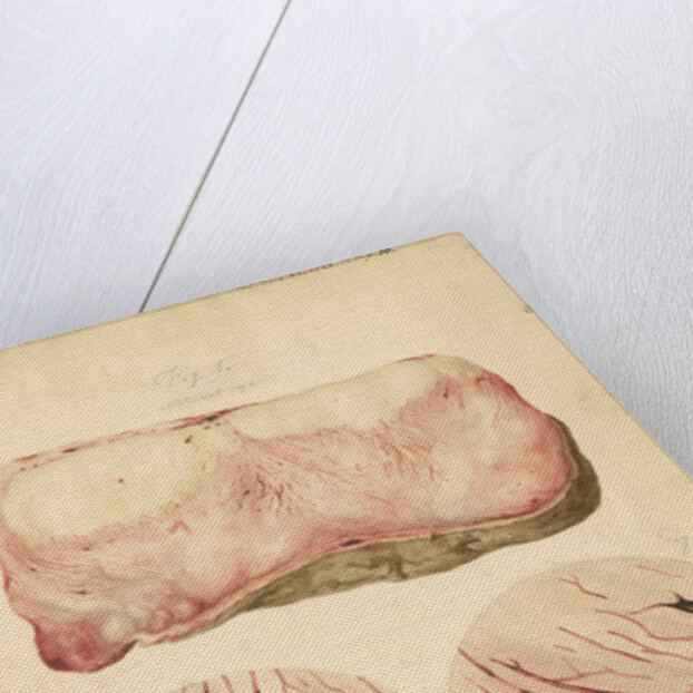 Tumor with human blood lymph cells by Franz Andreas Bauer