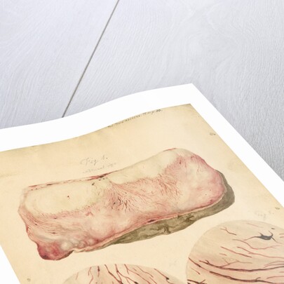 Tumor with human blood lymph cells by Franz Andreas Bauer