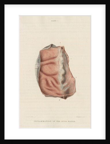 'Inflammation of the dura mater' by J Wedgewood
