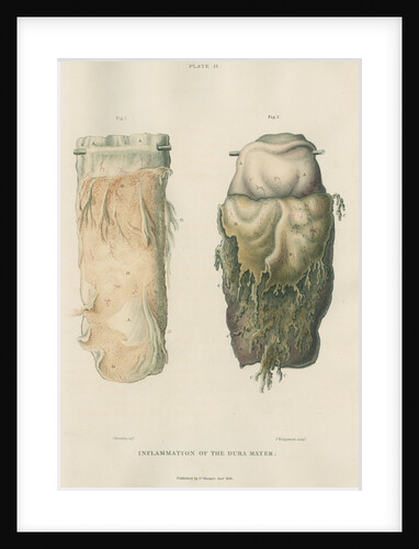 'Inflammation of the dura mater' by J Wedgewood
