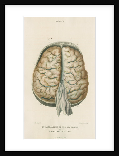 'Inflammation of the pia mater and tunica arachnoides' by J Wedgewood