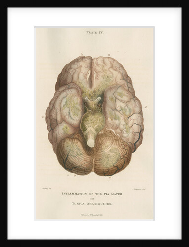 'Inflammation of the pia mater and tunica arachnoides' by J Wedgewood