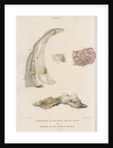 'Ossification of the dura and pia mater' by J Wedgewood