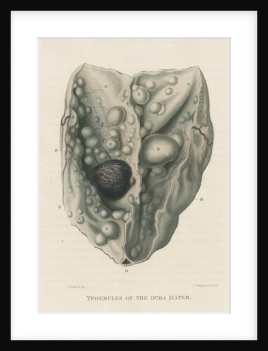 'Tumours of the dura mater' by J Wedgewood