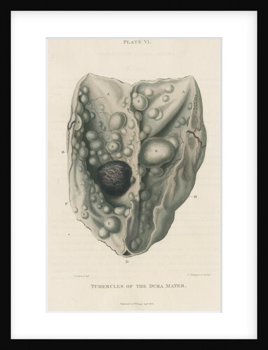 'Tumours of the dura mater' by J Wedgewood