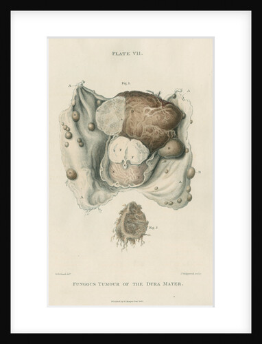 'Fungous tumour of the dura mater' by J Wedgewood
