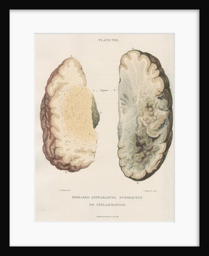 'Inflammation of the brain' by J Wedgewood