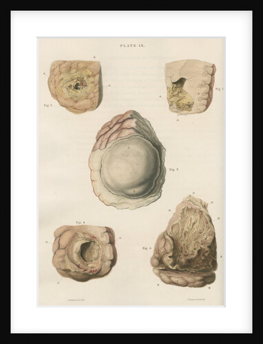 'Abscess of the brain' by J Stewart senior