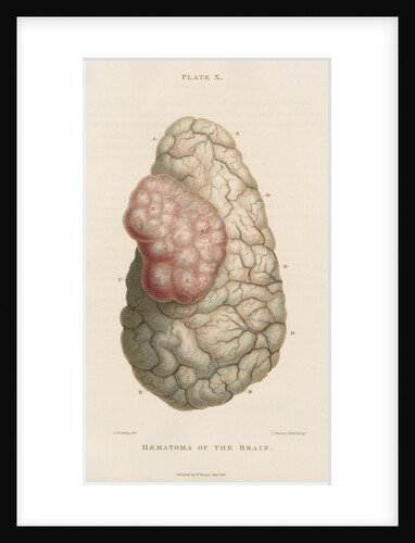 'Haematoma of the brain' by J Stewart senior