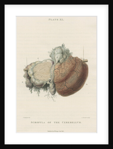 'Scrofula of the cerebellum' by J Stewart senior