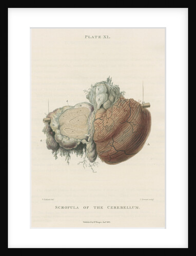 'Scrofula of the cerebellum' by J Stewart senior