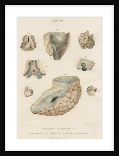 'Tubercles of the brain' by J Stewart senior