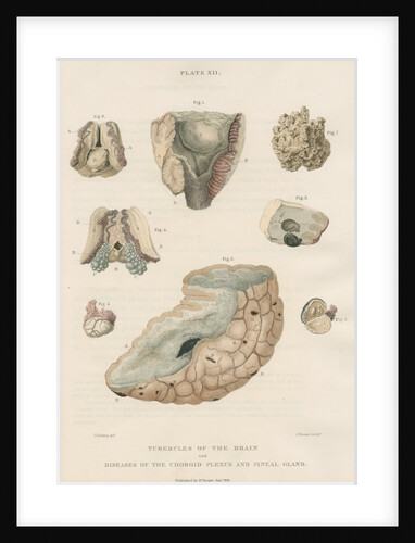 'Tubercles of the brain' by J Stewart senior
