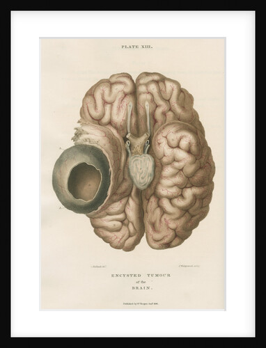 'Encysted tumour of the brain' by J Wedgewood