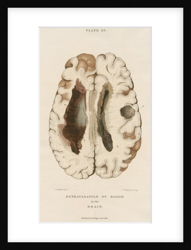 'Extravasation of the blood' by J Wedgewood