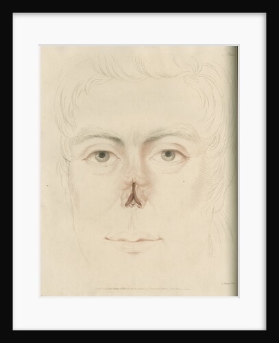A candidate for a nose replacement by Charles Turner