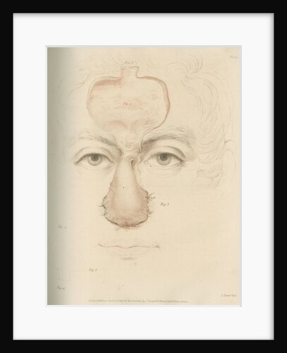 The Indian Method of nose replacement by Charles Turner