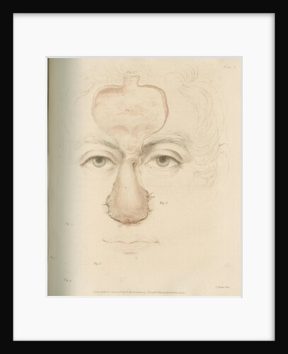 The Indian Method of nose replacement by Charles Turner