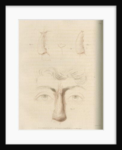 A successful nose replacement using the Indian Method by Charles Turner
