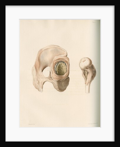 Hip and femur by G Hallmandel