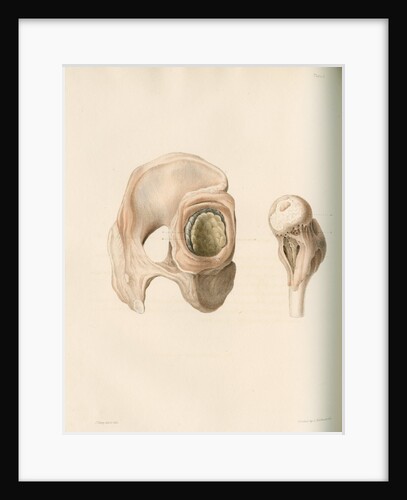 Hip and femur by G Hallmandel