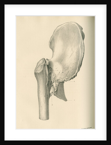 Lateral view of anchylosis of the right femur with the hip bone by J Perry