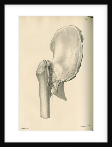 Lateral view of anchylosis of the right femur with the hip bone by J Perry