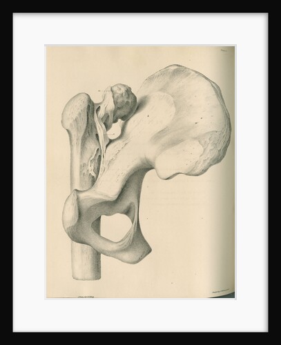 Posterior view of a left dislocated femur and hip bone by J Perry