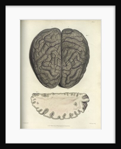 'Extreme cerebral congestion' by William Thomas Fry