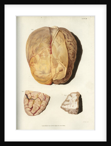 'Effects of jaundice on the brain and its membranes' by William Thomas Fry