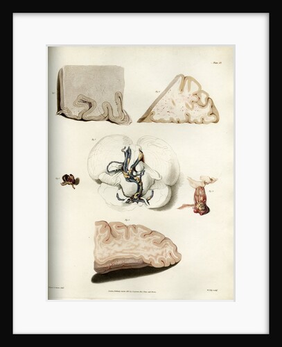 'Congestion in the minute vessels of the brain' by William Thomas Fry