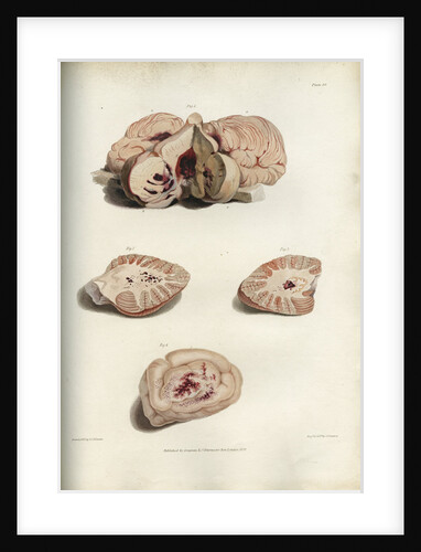 'Apoplexy and concussion' by C J Canton