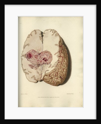 'Cyst in the brain' by William Say