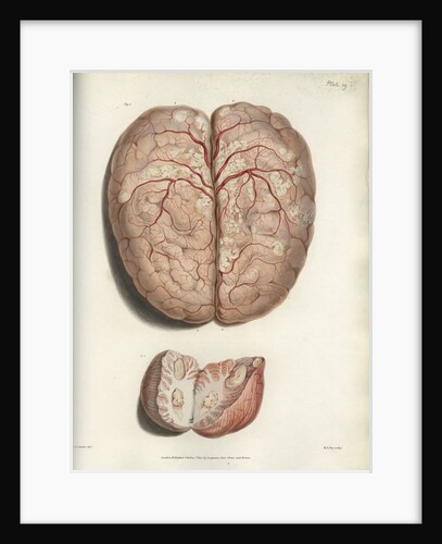 'Scrofulous tubercles in the brain' by C J Canton