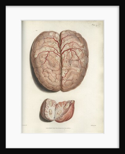 'Scrofulous tubercles in the brain' by C J Canton