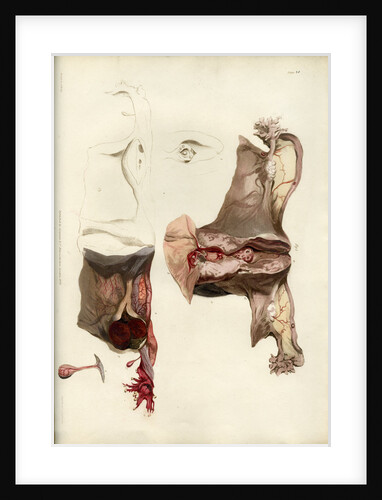 'Diseases of the uterus giving rise to excessive nervous irritation' by C J Canton