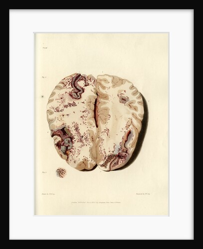 'Extravasion in the brain from obstructed circulation' by William Say