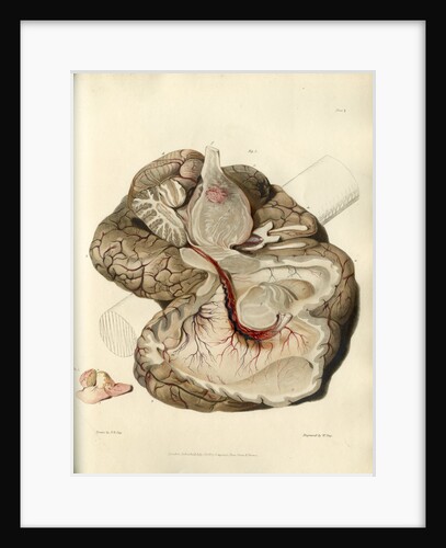 'Tumour of the pons Varolii' by William Say