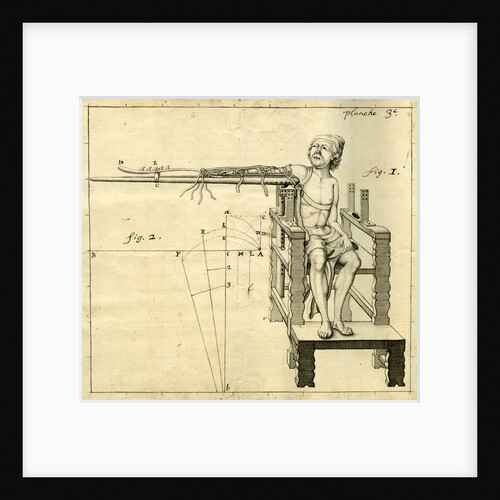 'Ambe of Hippocrates': contraption for repairing dislocated shoulders by Claude-Nicholas Le Cat