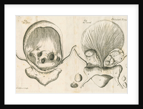 Human bladder and bladder stones by Elizabeth Blackwell
