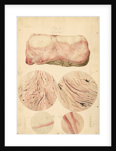 Tumor with human blood lymph cells by Franz Andreas Bauer