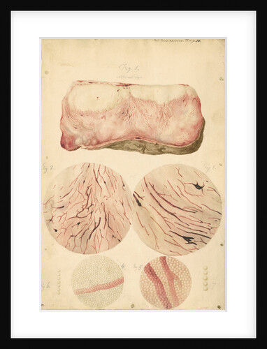 Tumor with human blood lymph cells by Franz Andreas Bauer