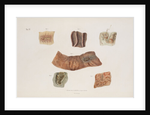 Alterations caused by cholera in the intestinal mucous membrane by d'Harlingue