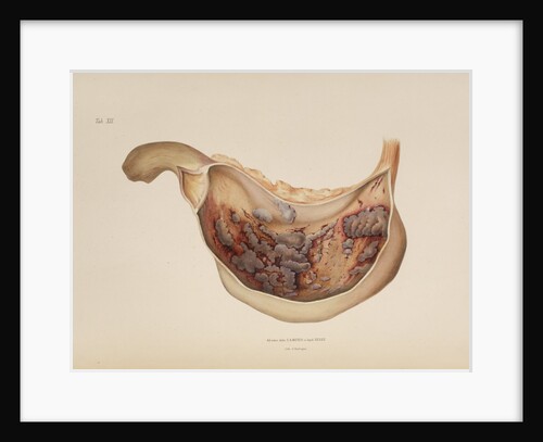 Effect of diphtheric-cholera on the mucous membrane of the stomach by d'Harlingue
