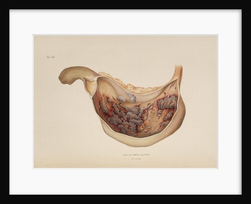 Effect of diphtheric-cholera on the mucous membrane of the stomach by d'Harlingue
