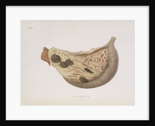 The stomach of a victim of cholera by d'Harlingue