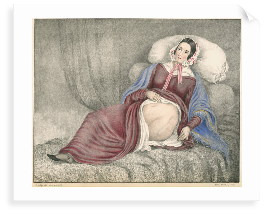 Portrait of Elizabeth Powis showing a leg amputation by Leonard