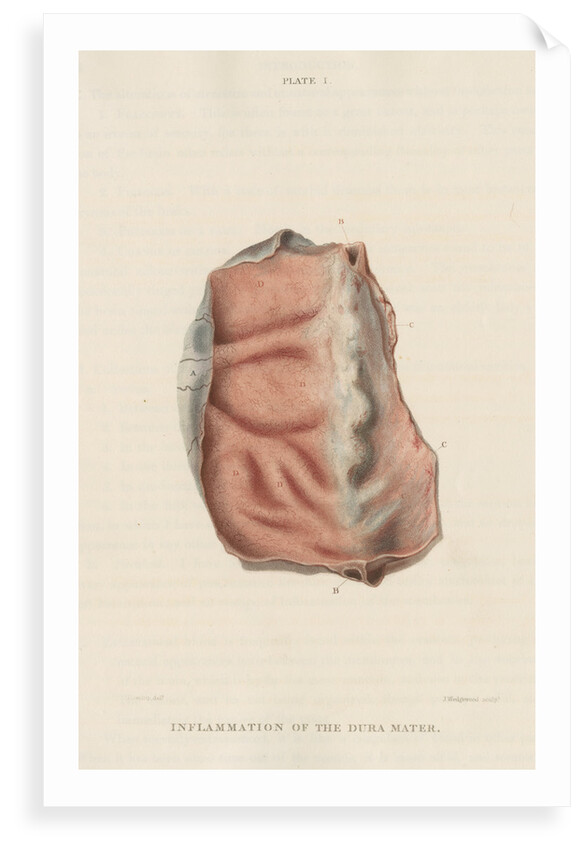 'Inflammation of the dura mater' by J Wedgewood