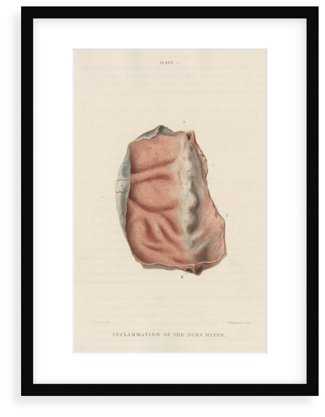 'Inflammation of the dura mater' by J Wedgewood