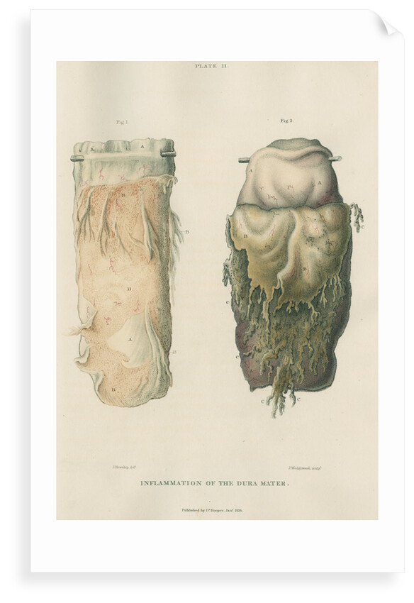 'Inflammation of the dura mater' by J Wedgewood